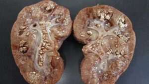 Dr. Josué Vieira - Nefrologista em Campo Grande (MS) Múltiplos cálculos em ambos os rins que levou a perda de função renal e necessidade de cirurgia por infecção renal grave.