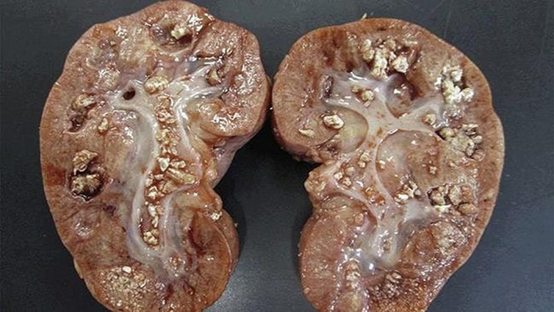 Dr. Josué Vieira - Nefrologista em Campo Grande (MS) Múltiplos cálculos em ambos os rins que levou a perda de função renal e necessidade de cirurgia por infecção renal grave.